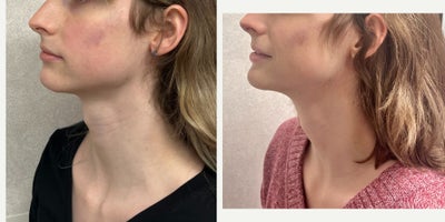 18-24 year old woman treated with Adam's Apple Reduction, Genioplasty, Facial Feminization Surgery - This lady underwent an adam's apple reduction and mandible/chin feminization.