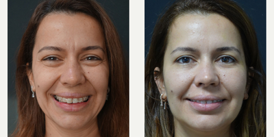 35-44 year old woman treated with Facial Fat Transfer - Botox & Eyelid - Cheek Fat Injection