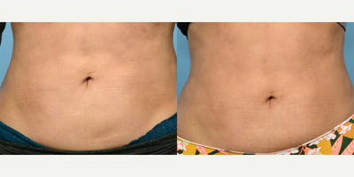 35-44 year old woman treated with Morpheus8 - This patient underwent 2 treatments of Morpheus8 to her abdomen to tighten the skin as she was complaining of laxity issues. Post-treatment photos were taken after 4 months.