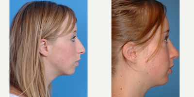 18-24 year old woman treated with Chin Implant - Rhinoplasty and chin implant