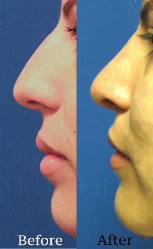 Woman treated with Rhinoplasty - Woman treated with Rhinoplasty