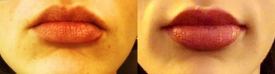 Ultherapy - Juvederm Ultra Plus, Volbella, Botox, Ultherapy lip plump