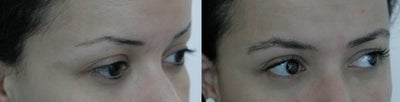 Eyebrow Transplantation - Eyebrow transplantation surgery by FUT method to thicken the eyebrows.5 Months after the surgery.