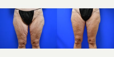 45-54 year old woman treated with Breast Augmentation, Breast Lift, Breast Implants, Thigh Lift - This 47 year old patient lost about 155 lbs over the past 5 years with a gastric sleeve followed by maintenance with Mounjaro. She has already had a tummy tuck. Her breasts are flat, atrophied, ptotic, very little tissue. She wants a nice full cup, small D, full C. She is asymmetric. We have decided to go with a 350 for her larger left and a 375 for her smaller right. We also decided to do the vertical medial thighplasty to remove the redundant skin of her inner thigh, which is very flabby.