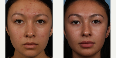 18-24 year old woman treated with HydraFacial - Before:  22 year old female with acne and acne scars, large pores, uneven skin tone.After:  Patients skin looks amazing after a combination of Hydrafacials to cleanse the skin, Isolaz to treat her acne, and Laser Facials (photo facials) to even out her skin tone.