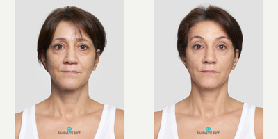 35-44 year old woman treated with Dermal Fillers - Threadlift Brows