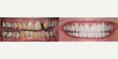 65-74 year old man treated with Full Mouth Reconstruction - Male patient had a fractured front tooth, he also suffered from severe bruxism and he had worn his teeth severely, losing natural appearance and therefore his smile was compromised. After a full diagnostic visit, we reviewed different aspects, his occlusion, amount of wear, susceptibility to potential fractures if the entire mouth was not addressed. It is important to take a look at the mouth as a whole, this patient understood the importance of looking at the big picture instead of focussing in one tooth. Patient trust the process and he loved the results!.