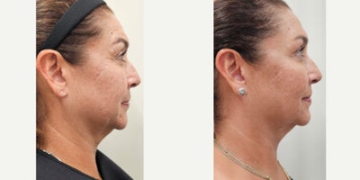 55-64 year old woman treated with Dysport, Sculptra, Radiesse, Alastin Skincare - Tailored treatment plan with combined procedures on same session: Dysport on upper third of the face2 vials of Sculptra for the whole face2 vials of reconstituted Radiesse for the neckAlastin Skincare started after her first consultation