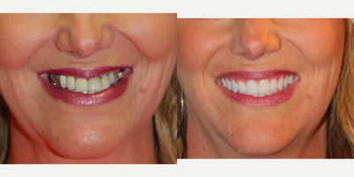 All-on-4 Dental Implants - All-on-4 Dental Implants