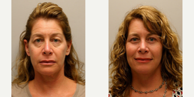 Woman treated with Brow Lift - Woman treated with Brow Lift as well as Deep Plane Facelift, Submentoplasty, Upper and Lower Blepharoplasty, Temple Brow Lift, and Facial Fat Transfer from abdomen. Pre-op, she was concerned looking tired. She had tried Botox and fillers in the past but they did not fully treat the neck laxity and extra eyelid skin.