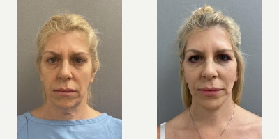 55 year old woman treated with Eyelid Surgery - 55 year old woman treated with Eyelid Surgery
