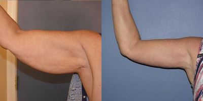 Woman treated with Arm Lift - Beautiful arm lift where the scar is hidden.