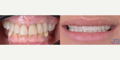 Woman treated with Smile Makeover, Teeth Whitening - Woman treated with Smile Makeover, Teeth Whitening