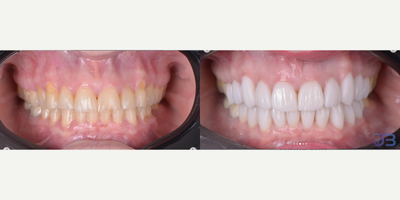Woman treated with Porcelain Veneers - Woman treated with Porcelain Veneers