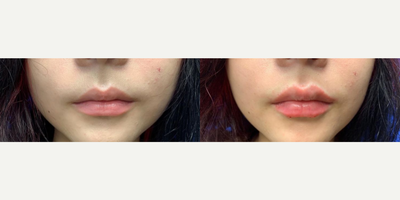 Woman treated with Juvederm - Woman treated with Juvederm Ultra for added volume and enhancement