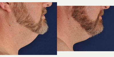 43 yo male treated with CoolSculpt - 43 yo male treated with CoolSculpting-12 weeks post treatment #2 Submental, Upper/Lower Abdomen, Bilateral Flanks and Bilateral inner thighs.
