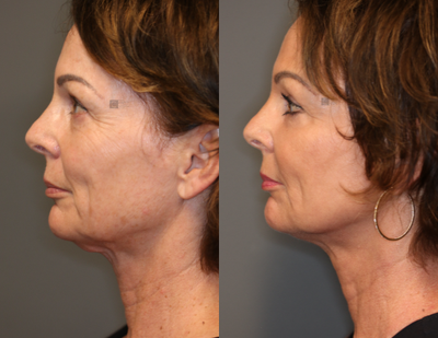 Non Surgical Rejuvenation - Filler, neck tightening and laser.