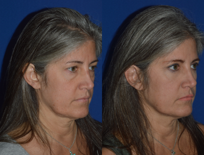 45-54 year old woman treated with Eyelid Surgery - Upper and lower blepharoplasty in the office under local anesthesia.