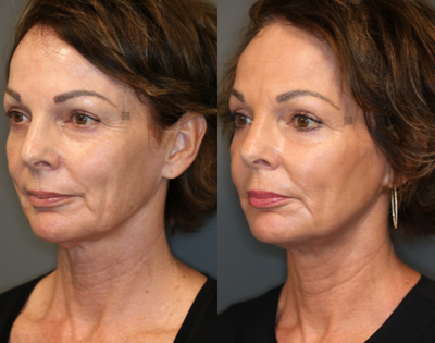 Non Surgical Rejuvenation - Filler, neck tightening and laser.