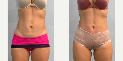 35-44 year old woman treated with Emsculpt - This woman in her early forties attended the Emsculpt Neo bus tour and signed up for four abdomen sessions with our body contouring specialist Jessica. She looks wonderful and is pictured before and after two months of treatment.