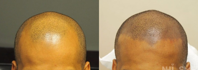 25-34 year old man treated with Hair Loss Treatment Scalp MicroPigmentation SMP - Scalp MicroPigmentation SMP