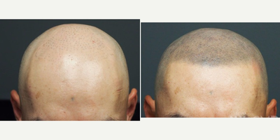 35-44 year old man treated with Hair Loss Treatment Scalp MicroPigmentation (SMP) - Scalp MicroPigmentation (SMP)