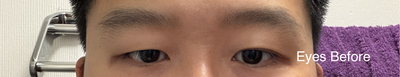 Eyes before (no double-eyelid + asymmetrical)