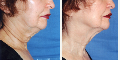 65-74 year old woman treated with Titan - one titan treatment to this woman's neck and lower face worked amazingly well! She was thrilled!