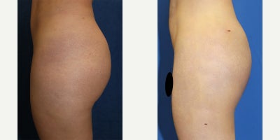 VASER Ultrasound, closed silicone removal for pain relief and buttock contour - Our patient is a 28-year-old White male who came to Dr. Timothy Katzen with buttock discomfort and pain after silicone injections performed by another surgeon. Because free silicone can migrate, trigger inflammation, and create firm pockets, Dr. Katzen recommended a closed silicone injection removal using an ultrasound-guided, VASER-assisted method, a silicone removal technique designed to break up and evacuate silicone through small access points rather than large open incisions when the distribution is appropriate. Under general anesthesia, Dr. Katzen first assessed the affected regions to plan the safest and most effective site for removal. He then created tiny, strategically placed openings and used VASER ultrasound energy to gently emulsify the silicone and reactive fluid, thereby separating unwanted material from healthier tissue. A specialized cannula was used to suction out the loosened silicone in a controlled, step-by-step pattern, reducing the risk of unevenness. Throughout the procedure, Dr. Katzen focuses on protecting the skin, avoiding over-aggressive removal, and maintaining smooth contours. Post-operative care includes compression and ambulation to promote venous return, with follow-up to monitor for swelling. These photos were taken one week after surgery. While firmness is still expected at this stage, he already appears markedly improved and reports feeling relieved of most of his pain as healing continues and inflammation subsides.