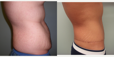 25-34 year old man treated with Male Tummy Tuck - This patient underwent a Tummy Tuck (Abdominoplasty) , specifically an Around the World Abdominoplasty.