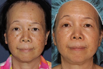 50 year old Asian female treated for brown spots and age spots - 
	50 year old Asian female came in concerned with brown spots, age spots and moles on her face. I treated her one time with the Fraxel Dual, q-switched alex, and shave/curetting technique. She only needed one treatment.
