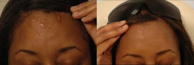 Profractional Laser Resurfacing for Scars - Before and After Photos - 
	Profractional Laser Resurfacing before and after pictures for African American scars caused by a car accident and glass fragments. Before and after 1 Profractional laser resurfacing treatment
