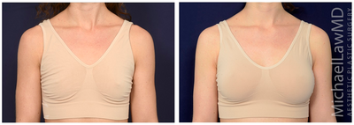 25-34 year old woman treated with Ideal Implant - Breast augmentation. Follow-up photos taken 3 months after the procedure.