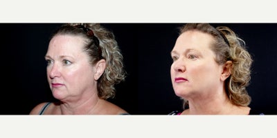 58 year old woman treated with Thread Lift - 58 year old woman treated with Thread Lift. Photos depict before and 3 months after 6 Instalift Sutures