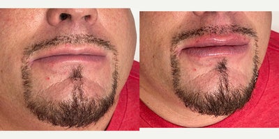 45-54 year old man treated with Restylane - Lip fillers by Radhika