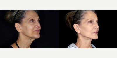 64 year old woman treated with Genioplasty (reduction) and necklift. - 64 year old woman treated with Genioplasty (reduction) and necklift. Photos depict before and 1 month after surgery.