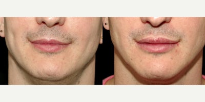 34 year old man treated with Lip Implants - 34 year old man treated with Lip Implants. Photos depict before and 1 month after surgery.