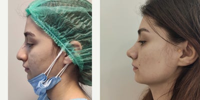 18-24 year old woman treated with Rhinoplasty - preservation rhinoplasty closed approach no internal splintsno cast