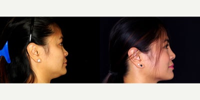 38 year old woman treated with Asian Rhinoplasty. - 38 year old woman treated with Asian Rhinoplasty. Photos depict before and 10 months after surgery.