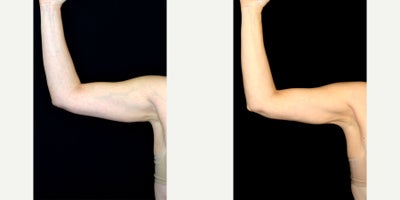 52 year old woman treated with Smart Lipo to arms - 52 year old woman treated with Smart Lipo to arms. Photos depict before and 1 year after surgery.