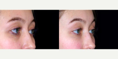 24 year old woman treated with Restylane Lyft to undereyes. - 24 year old woman treated with Restylane Lyft to undereyes. Photos depict before and 1 month after treatment.
