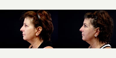 57 year old woman treated with Thread Lift - 57 year old woman treated with Thread Lift. Photos depict before and 1 month after 8 Silhouette Instalift Sutures.