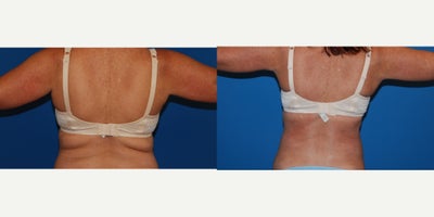 35-44 year old woman treated with Liposuction - Liposuction of Bilateral Flanks