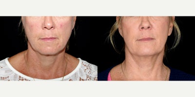 54 year old woman treated with Thread Lift. - 54 year old woman treated with Thread Lift. Photos depict before and 1 year after 10 Silhouette Instalift Sutures.
