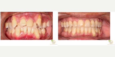 55-64 year old man treated with Clear Braces - Transformation of his smile with braces and extractions!