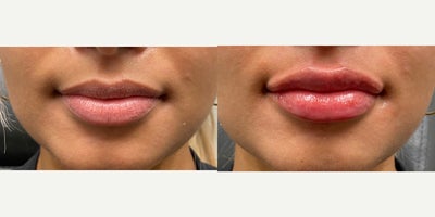 18-24 year old woman treated with Juvederm - Juvederm lip filler