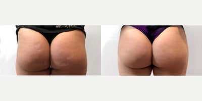 35-44 year old woman treated with Qwo - Patient wanted to reduce the appearance of growing cellulite and dimples on her buttocks.