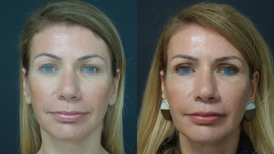 35-40 year old woman treated with Upper Lip Lift - Upper Lip Lift Surgery - 45days post-op
