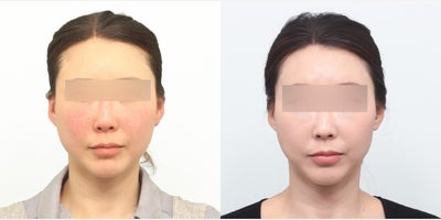 Woman treated with Skin Tightening - She was concerned about her face contour changing as she was aging. Also, she didnt like the enlarged pores, redness and frequent and stubborn acne on her chin region. Since she didnt have much fat a session of Thermage FLX (monopolar radiofrequency) was done for skin tightening/rejuvenation. Also, Rejuran (polynucleotide) injection was done for her redness and chin acne. After one session of Thermage and Rejuran, at her follow-up for botox, she was very satisfied with the results (at post-procedure 4 months). The skin tightening led her face contour to be more soft and defined like back when she was younger. Also, the Rejuran had led her to have a brighter face with less redness and less adult acne.