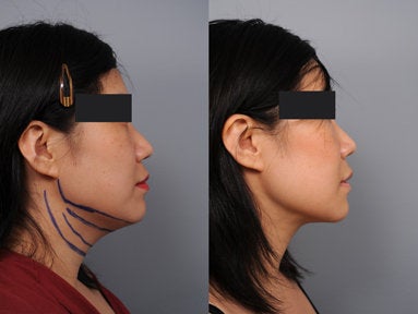 Smartlipo of the neck with Radiesse in the Mid-face - 
	40 year old woman complained that she no longer looked like her driver license photo. Smartlipo for the neck and Radiesse to the mid face completely rejuvenated her look.
